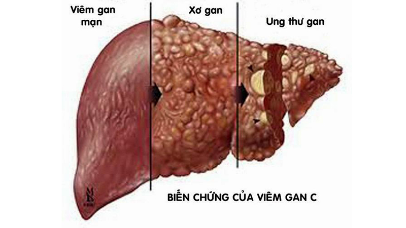 Các giai đoạn của bệnh viêm gan C